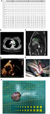 The surgical strategy of hormonally active primary cardiac paraganglioma sarcoma: A case report